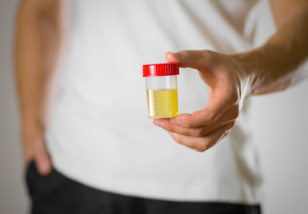 A man holding a plastic container of urine for a drug test with clonazepam